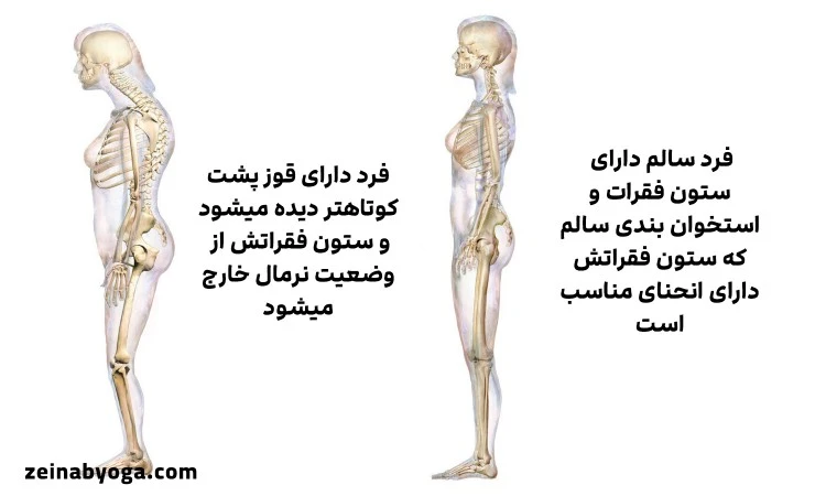 علائم قوز پشت چیست؟